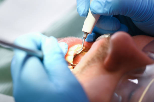 Best Emergency Tooth Extraction in Mankato, MN